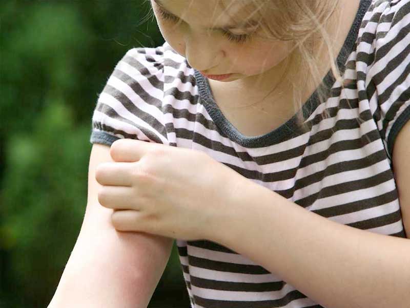Young girl scratching a mosquito bite on her arm